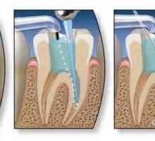 Endodontskog liječenje zubi. Faze endodontskog