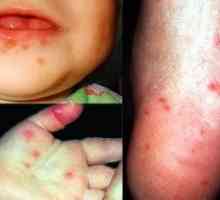 Enterovirus infekcije kod djece: liječenje, simptomi, prevencija