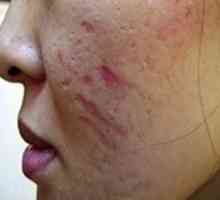 Kako da biste dobili osloboditi od acne ožiljaka kod kuće