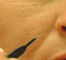 Kako se riješiti ožiljaka? Kabina metode za dobivanje osloboditi od acne ožiljaka