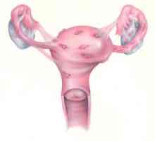 Kako liječiti endometriozu? endometrioza: što je to i kako se zaštititi od ove bolesti