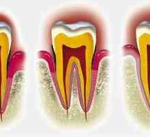 Kako liječiti parodontnih bolesti u ranim fazama bolesti