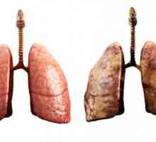 Kako liječiti upalu pluća ispravno