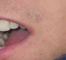 Kako liječiti perleches usne u kutovima popularnih načina i primjenom lijekova