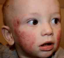 Kako kožnih bolesti u djece