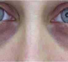 Kako ukloniti tamne krugove ispod očiju? Učenje učinkovite metode