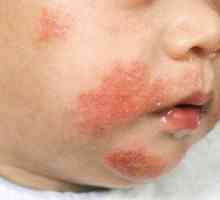 Što bi trebao biti lijek za djecu od alergija