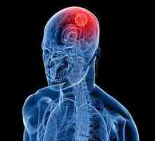 Što je simptom raka mozga je prvi poziv za buđenje?