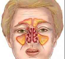 Koji su simptomi sinusitisa? liječenje bolesti