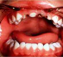 Zubni karijes u djece. Uzroci, liječenje, prevencija