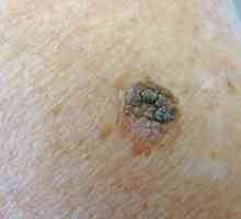 Keratomas - što je to? Liječenje kožnih keratomas