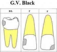 Klasifikacija prema crnoj šupljina: opis, stupanj klase i liječenje