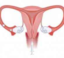 Kada se koristi intrauterini osjemenjivanje?