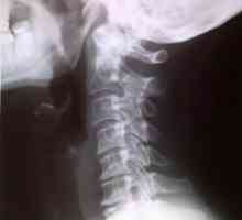 Gruda u grlu s osteochondrosis od vratne kralježnice: simptomi, liječenje