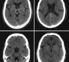 Kompjutorizirana tomografija mozga: Postupak ocjenjivanja