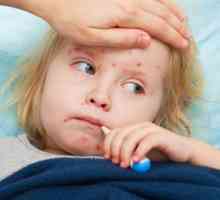 Ospice je dijete: Simptomi i liječenje
