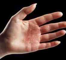 Lijevo dermatitis na rukama: liječenje