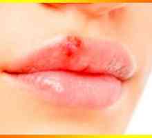 Lijevo herpes, ili kako se postupa hladno na usnama