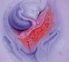 Granični placenta previa - prijetnja normalnom tijeku trudnoće
