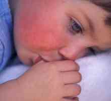 Crvena mrlja na obrazu bebe: uzroci, simptomi i karakteristike liječenja