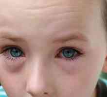 Crvene oči kod djece - prigoda konzultirati oftalmologa