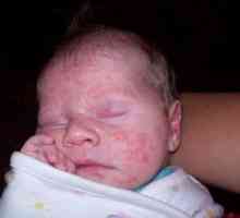 Crvene bubuljice na licu novorođenčeta