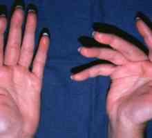 Liječenje artritisa prstiju