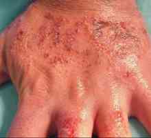 Liječenje dermatitis na rukama dostupnih načina
