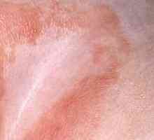 Liječenje pelenskog osipa u prepone u muškaraca: najučinkovitije načine