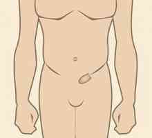 Liječenje preponski kila u muškaraca bez operacije. Liječenje narodnih lijekova