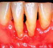 Liječenje parodontnih bolesti narodnih metoda