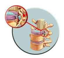 Liječenje spinalne hernije: osnovne tehnike