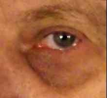 Liječenje modrica ispod oka i popularne medicinske metode