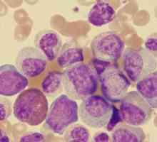 Leukemija - što je to? Kako je dijagnoza točna?