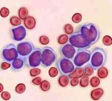 Leukemija - to je zastrašujuće? Simptomi i uzroci