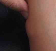 Lipom (masnih tumora) na nogama: uzroci, simptomi i liječenje