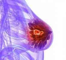 Mikrokalcifikati u prsa - što je to? Uzroci, dijagnoza