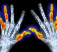ICD: reumatoidni artritis 10. Simptomi i liječenje