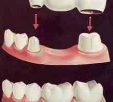 Most: pro i kontra. Preporuke zubara i izjave bolesnika