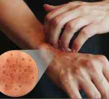 Atopijski dermatitis na rukama: etiologija, klinička obilježja tretmana