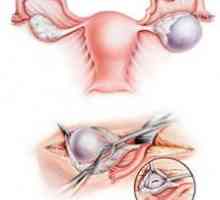 Opstrukcija jajovode: kako da biste dobili trudna, kako se izliječiti