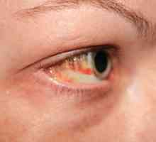 Što praska krvne žile u oku?