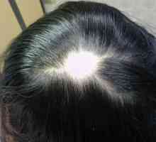 Gubitak kose u žena: Uzroci, liječenje. Sredstva za ćelavost kod žena