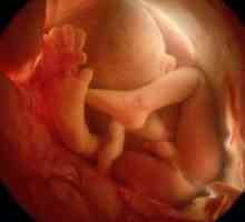 Zaplitanja pupčanu vrpcu oko vrata fetusa: kao što je to opasno?