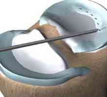 Operacije koljena na meniska: recenzije. Rehabilitacija nakon operacije na meniskusa koljena