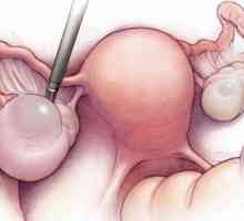 Operacije za uklanjanje ciste jajnika