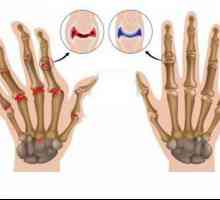 Obilježja statusa i liječenju bolesnika s reumatoidnim artritisom
