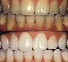 Izbjeljivanje zubi: vrste postupaka i mogućnosti njegovog ponašanja