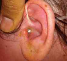Otitis media uho: liječenje, simptomi i uzroci