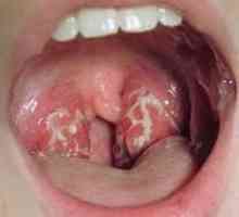 Gdje aureus u grlu. simptomi infekcije